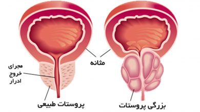 جراحی پروستات