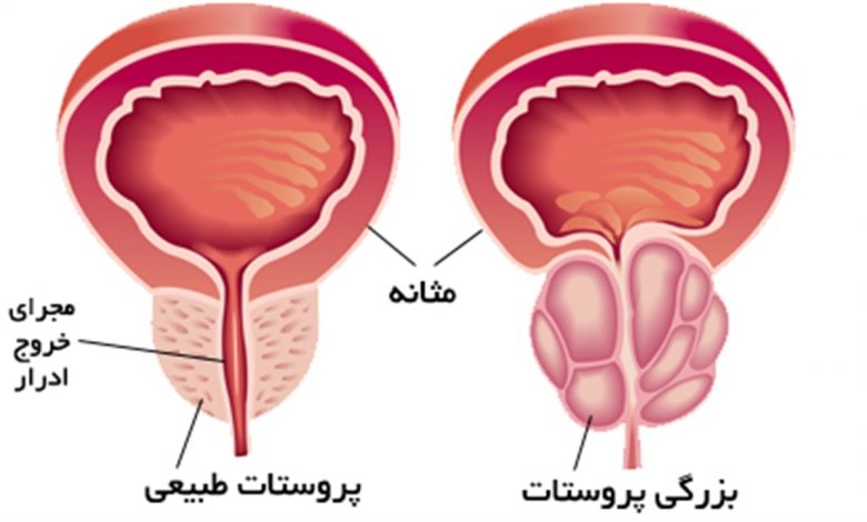 جراحی پروستات