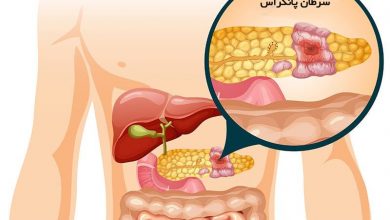 جراحی سرطان لوزالمعده