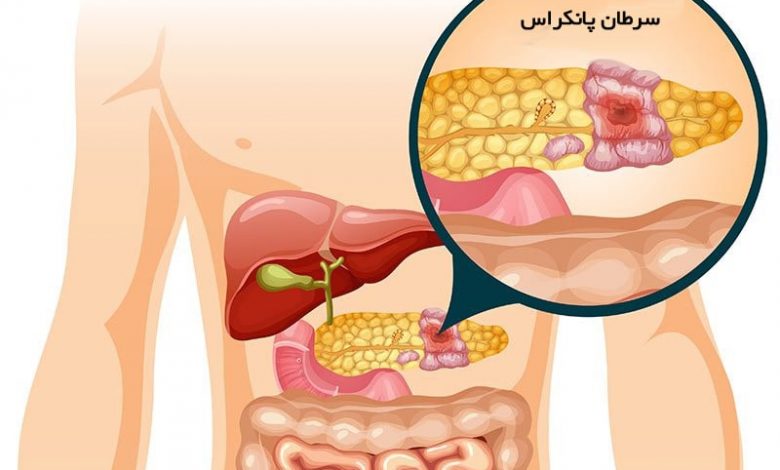 جراحی سرطان لوزالمعده