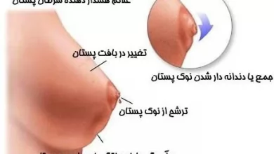 سرطان پستان
