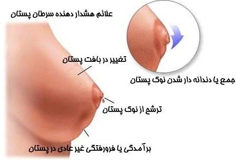 سرطان پستان