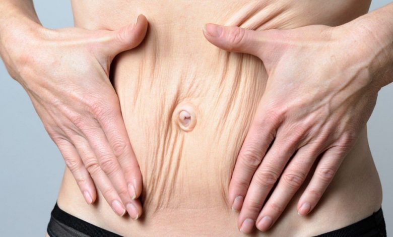 مزایا و معایب عمل ابدومینوپلاستی چیست؟