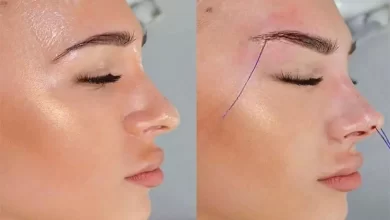 لیفت شقیقه