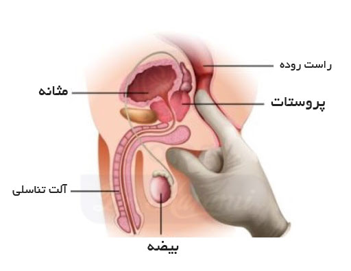 علائم پروستات
