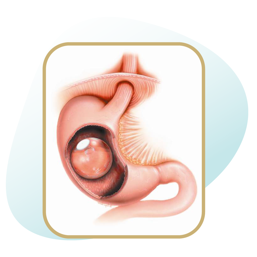 بالن معده